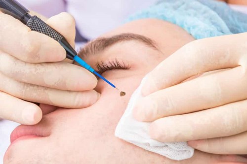Skin Service - Warts Removal