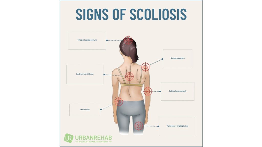 The impact of scoliosis