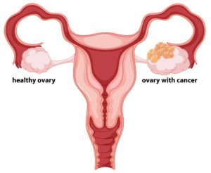 Ovarian Cancer