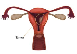 Endometrial cancer (Uterine cancer)